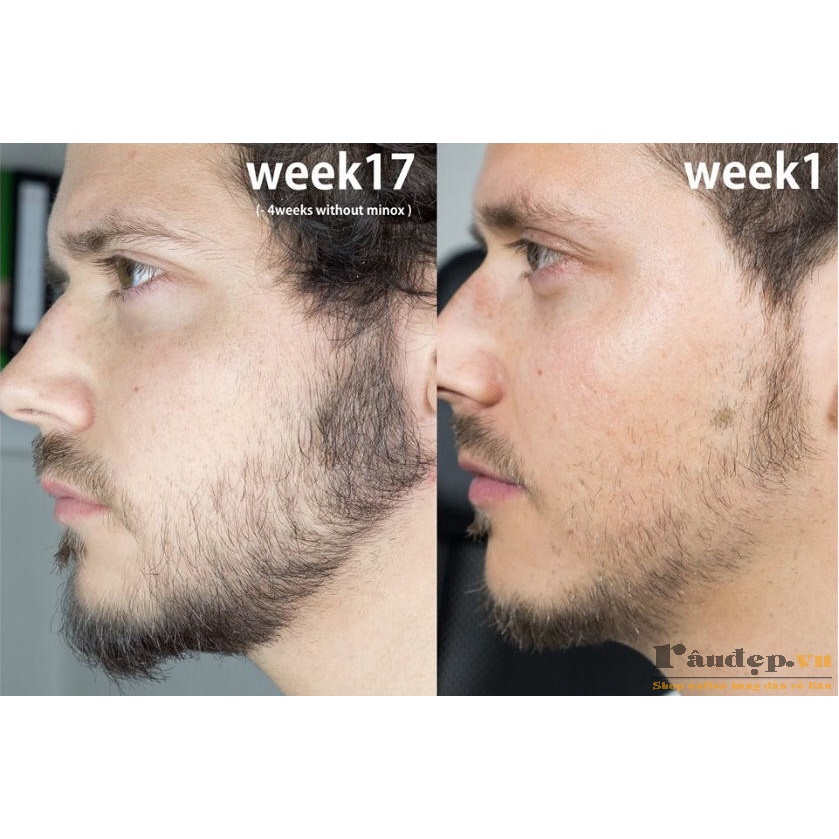 Minoxidil 5% Hỗ Trợ  Mọc Râu Tóc Kirkland