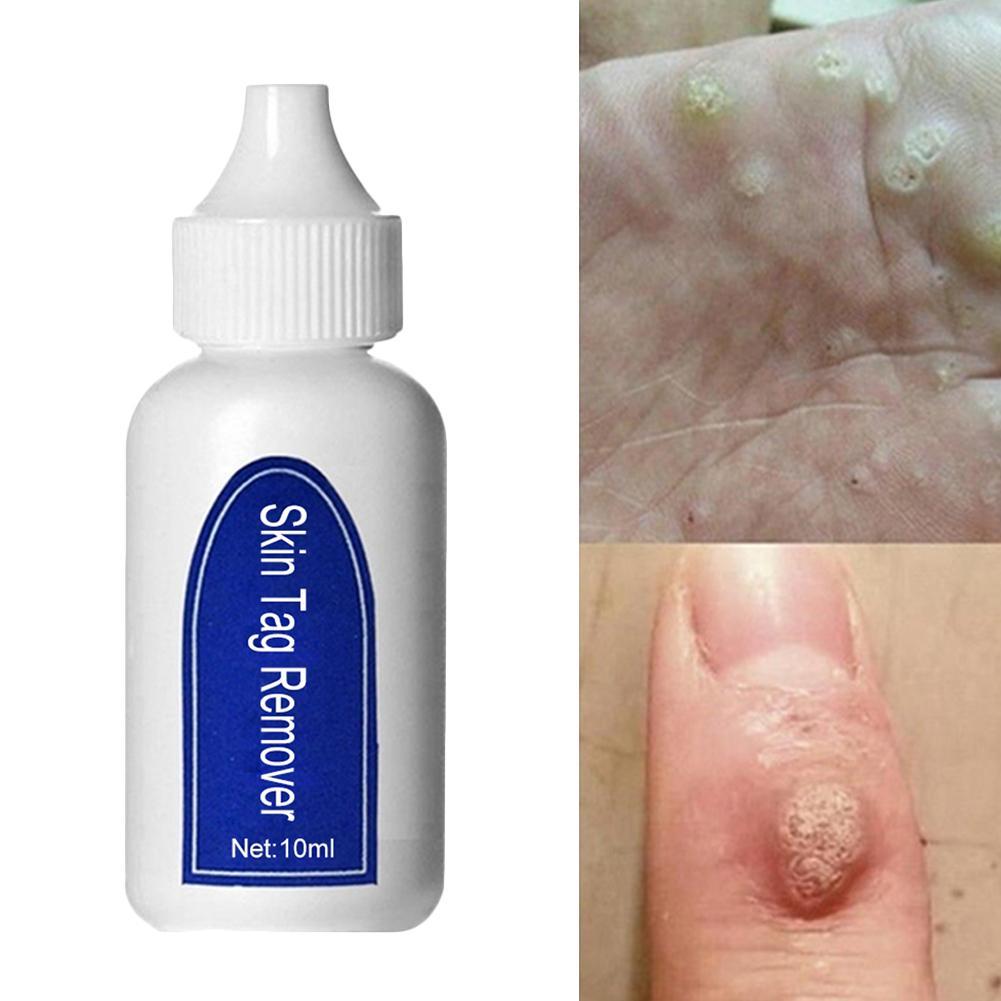 (Hàng Mới Về) Dung Dịch Trị Mụn Cóc 6ml Agai E6M6