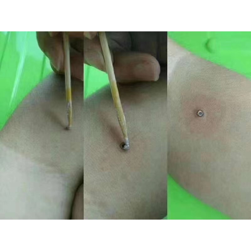 Kem tẩy nốt ruồi chấm nám tàn  nhang