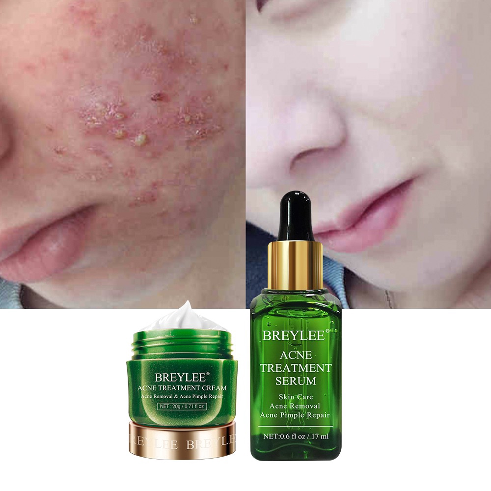 Serum hỗ trợ giảm Mụn BREYLEE 17ML+Kem hỗ trợ giảm Mụn Breylee 20g