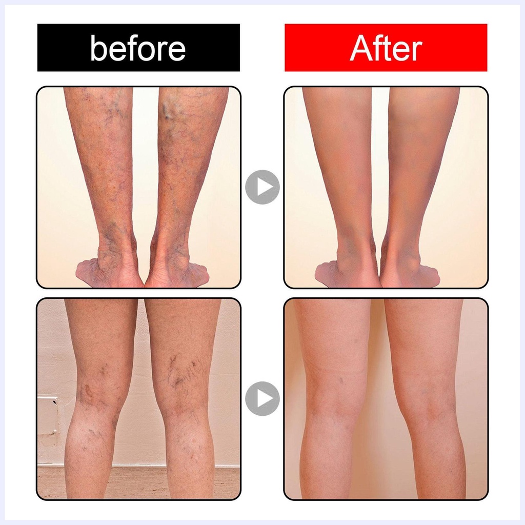 Bài chữa tĩnh mạch đăng giảm đau sưng chân giun đất chữa phình gân xanh chữa cao dán