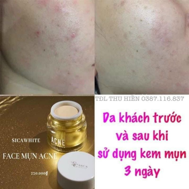 face mụn thâm sica white