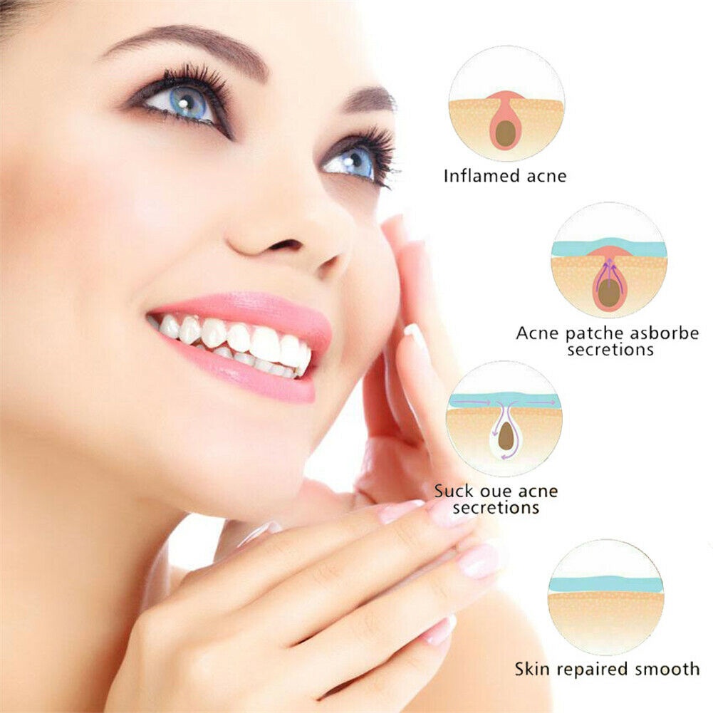 ♕38 Miếng Dán/1 Túi Miếng Dán Mụn Trứng Cá Miếng Dán Mụn Trứng Cá Vô Hình Thoáng Khí Miếng Dán Điều Trị Mụn Lành Vết Thâm Chống Thấm Nước Nhãn Dán Chăm Sóc Da Mặt UPBEST