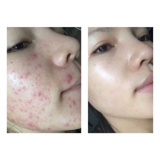 Mặt Nạ Thải Độc CO2 DJ Carborn Therapy làm dịu da kích ứng, làm giảm mụn sưng đỏ