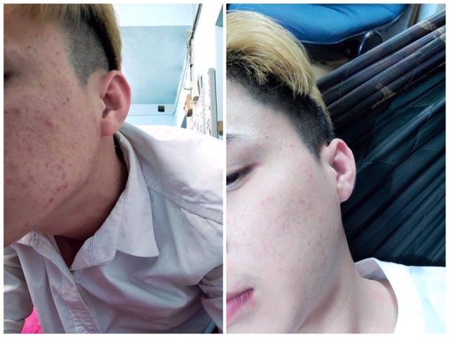 CAO MỤN SÂM ĐỎ FULLBOX 15GR | BigBuy360 - bigbuy360.vn