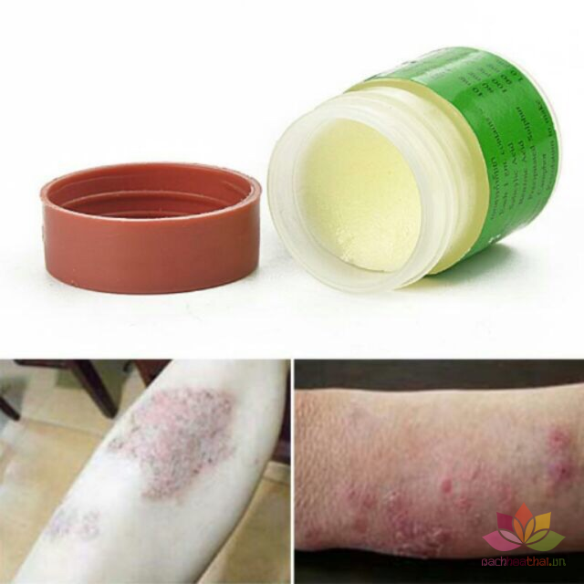 Kem ṫrị lanǥ ƅen Thái Lan 29A