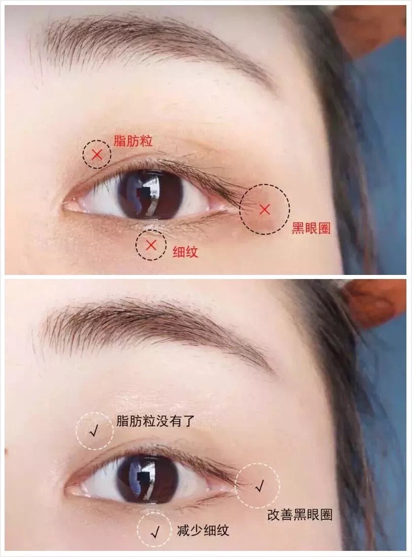 Yolo ❤ Đặt hàng để được mát xa! Korea Coreana Korea Botox Eye Cream, làm săn chắc và giảm nếp nhăn và quầng thâm 30ML | BigBuy360 - bigbuy360.vn