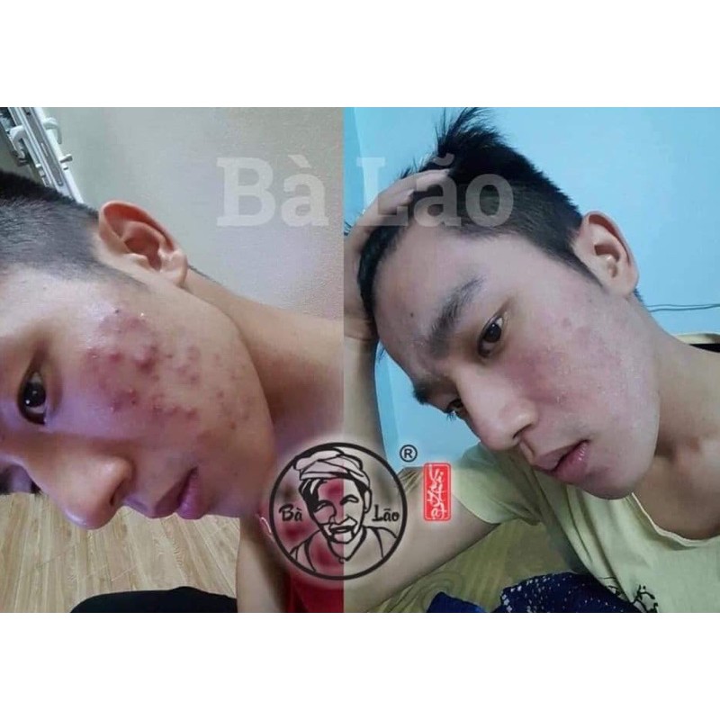 SERUM MỤN THÂM SẸO NÁM CAO CẤP-BÀ LÃO