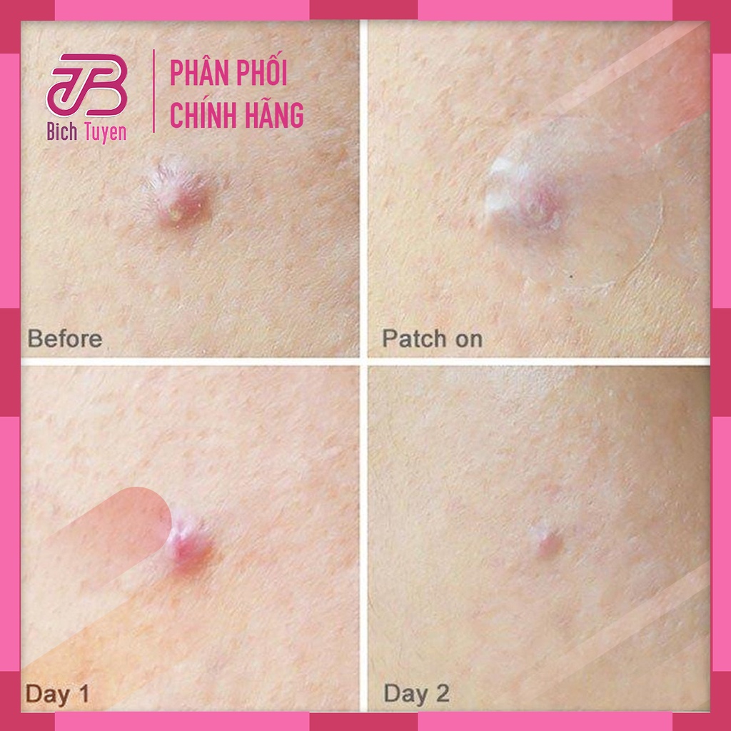 Miếng Dán Mụn Mayan care - 20+4 miếng - MAYANCARE - Miếng Dán Giảm Mụn Mayan Care Spot Plus dán mụn trong suốt hút mụn