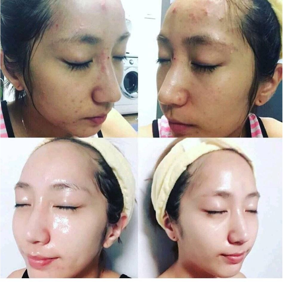 Đủ Bill, RED PEEL TINGE SERUM SONATURAL Chiết 15 ml/ Full - Thay da sinh học | BigBuy360 - bigbuy360.vn