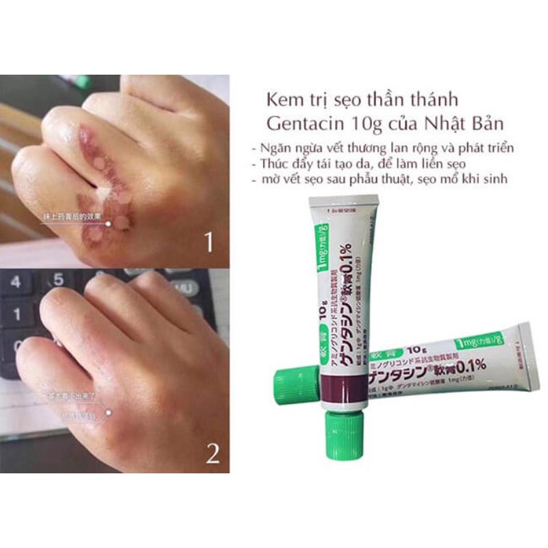 (Nhập khẩu chính hãng 💯) Kem sẹo Gentamicin Nhật số 1 về sẹo ( Bác sĩ khuyên dùng- có tại Nhà Thuốc)