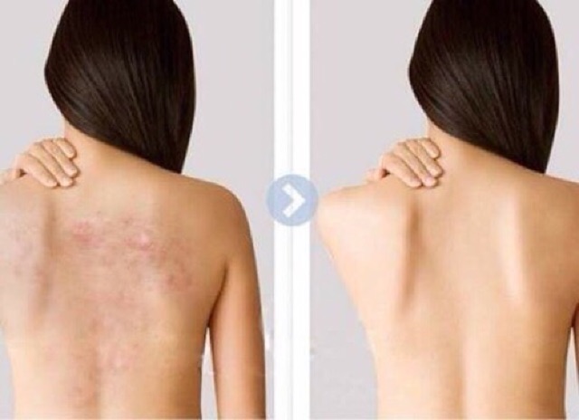 ❌XÀ PHÒNG TRỊ MỤN LƯNG, MỤN CƠ THỂ PELICAN FOR BACK CỦA NHẬT❌Có BILL Cam Kết CHÍNH HÃNG | BigBuy360 - bigbuy360.vn