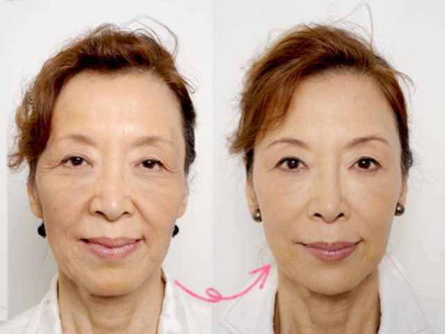 [ GOM SALE] serum Tinh chất HA mẫu mới | BigBuy360 - bigbuy360.vn