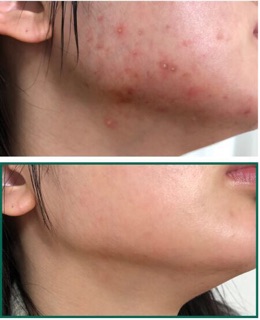 AHA – BHA – PHA 30 Days Miracle Toner
