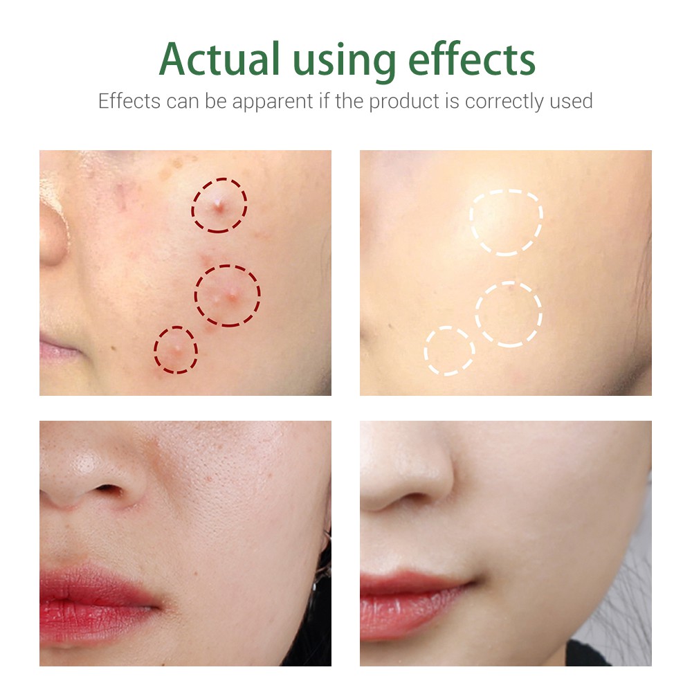 Bộ 6 Sản Phẩm Chăm Sóc Da BREYLEE Gồm Serum Kem Pimples Patch | BigBuy360 - bigbuy360.vn