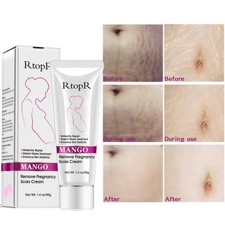 ♕ exo ღ RtopR Stretch Mark Cream For Pregnancy Repair Scar Slack Line Abdomen Stretch Marks Cream