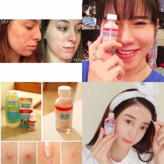 💥Chấm mụn khẩn cấp Bye bye Blemish For Acne
