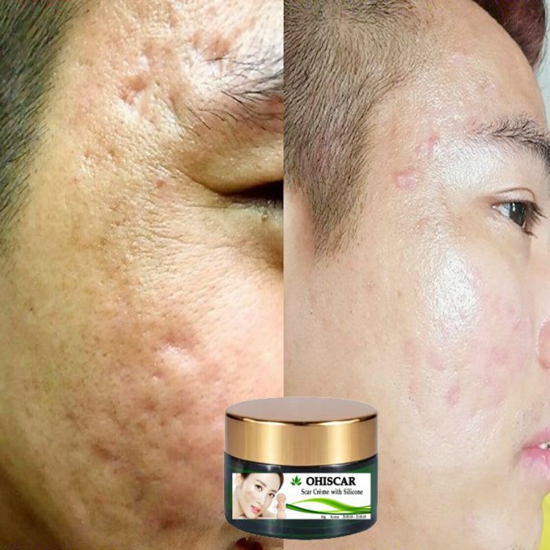 Serum & Kem Hổ Trợ Đầy SẸO RỖ Lâu Năm | BigBuy360 - bigbuy360.vn