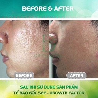 TẾ BÀO GỐC 5GF DRpluscell Ampoule