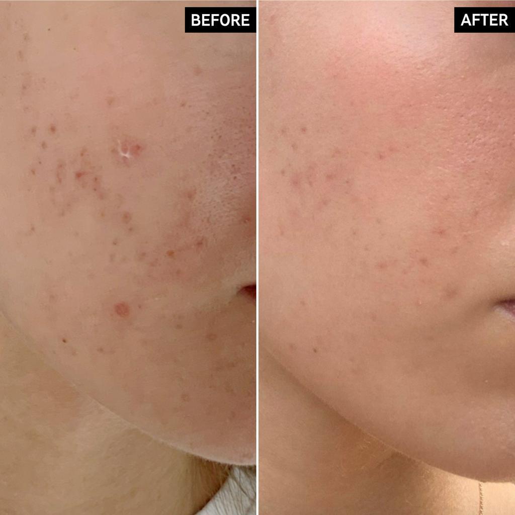 [Sephora US] Kem chấm mụn The inkey list MANDELIC ACID acne treatment 15ml