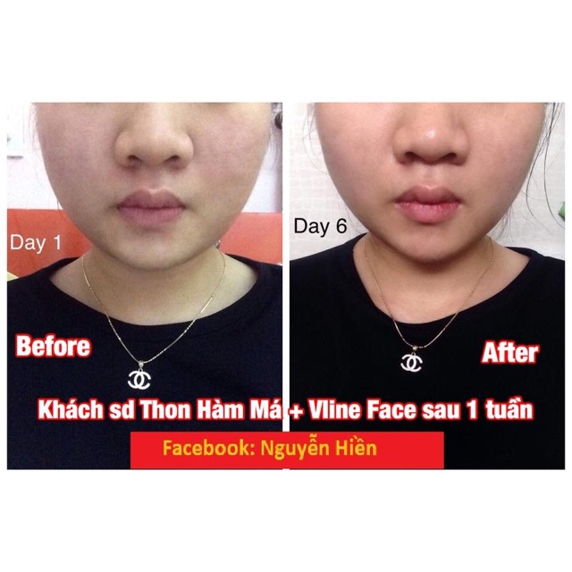 Tinh Chất Thu xương Vline Face Hàn