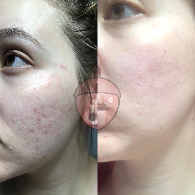 Serum sáng da Alpha Arbutin 2% + HA – The Ordinary.