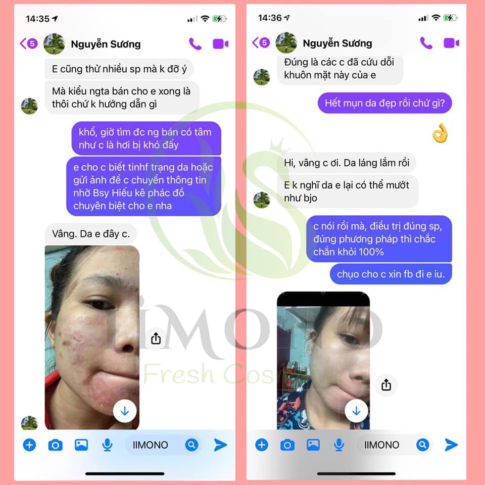 Bộ chăm sóc da mụn, giảm thâm mụn IIMONO | BigBuy360 - bigbuy360.vn