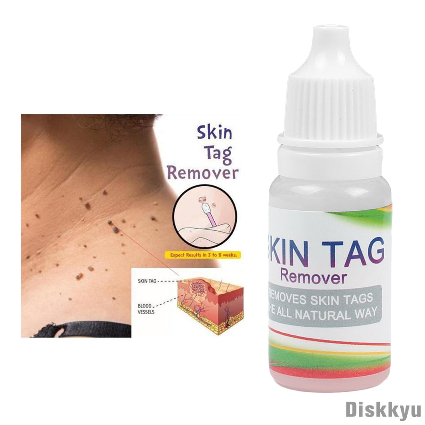 Beauty Home Use Safe Skin Tag Removal Liquid Fast Wart Tag Cure Remover