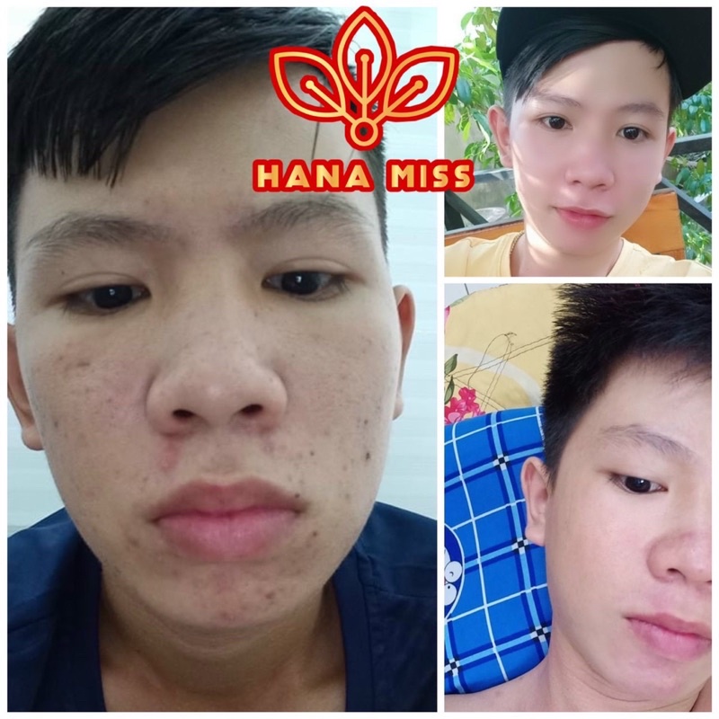 (Tặng 3 Mặt Nạ Kèm Theo)Hana Miss Peel Da Nhân Sâm | BigBuy360 - bigbuy360.vn