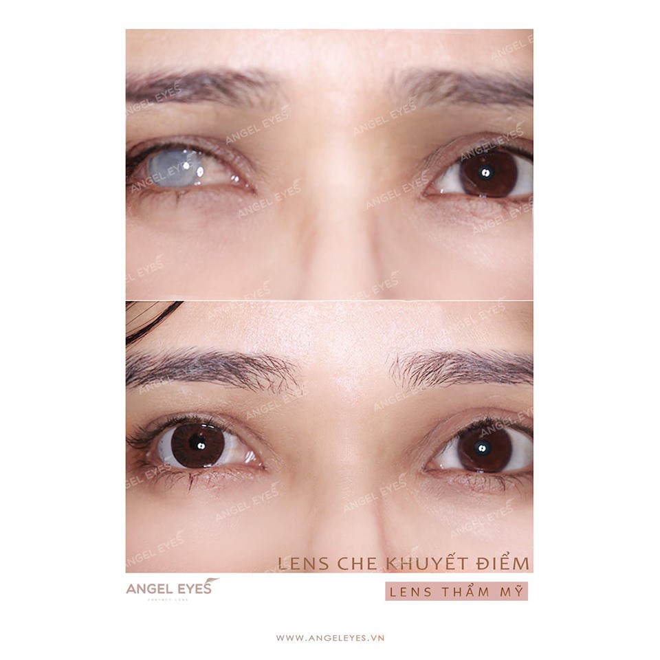 Kính áp tròng thẩm mỹ Angel Eyes dành cho mắt bị đục thủy tinh thế, kéo mây, cườm... | Lens che khuyết điểm