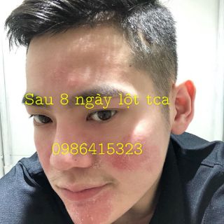PEEL THAY DA MẶT TCA DÀNH CHO NAM
