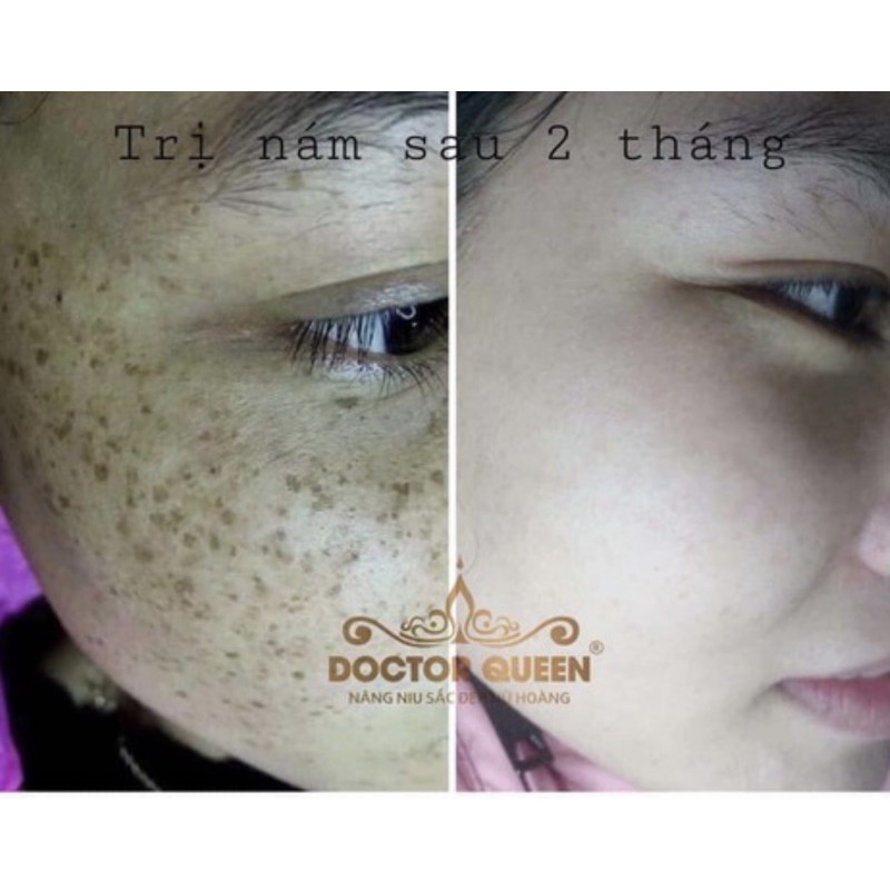 Kem nám DOCTOR QUEEN MELASMA PERFECT CREAM không lo lám tàn nhang mẫu mới | BigBuy360 - bigbuy360.vn