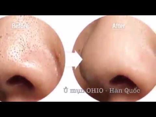 Ủ mụn Ohio Hàn Quốc