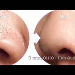 Ủ mụn Ohio Hàn Quốc