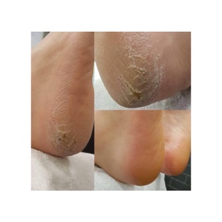 💥CHÀ GÓT CHÂN BALEA ĐỨC