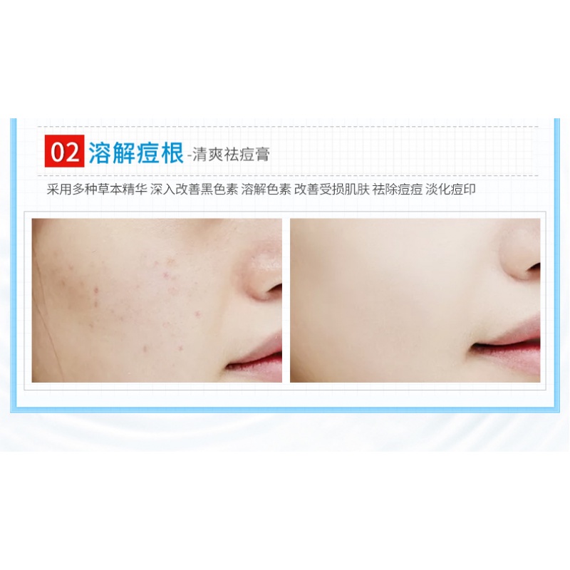 [Hàng mới về] Kem giảm mụn BEOTUA dưỡng ẩm và cân bằng dầu tiện lợi 30g