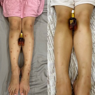 Tinh Chất Mờ Thâm Minh khang( tặng ngay 1 thâm gia truyền 120k)