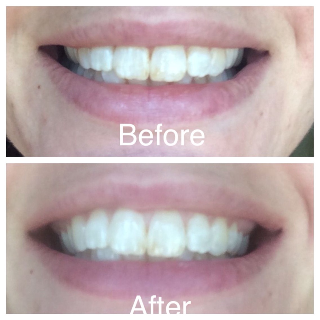 Bộ đôi kem đánh răng Crest 3D white Brilliance 2 Steps Tooth Paste