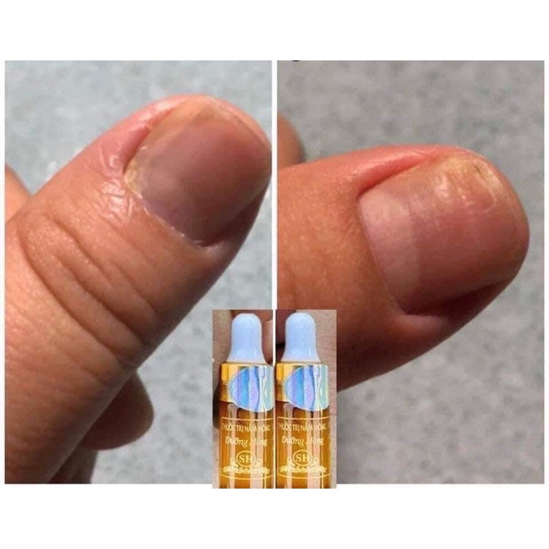 Liệu trình phục hồi nấm móng, hư khoé, bọng móng nước ăn chân.