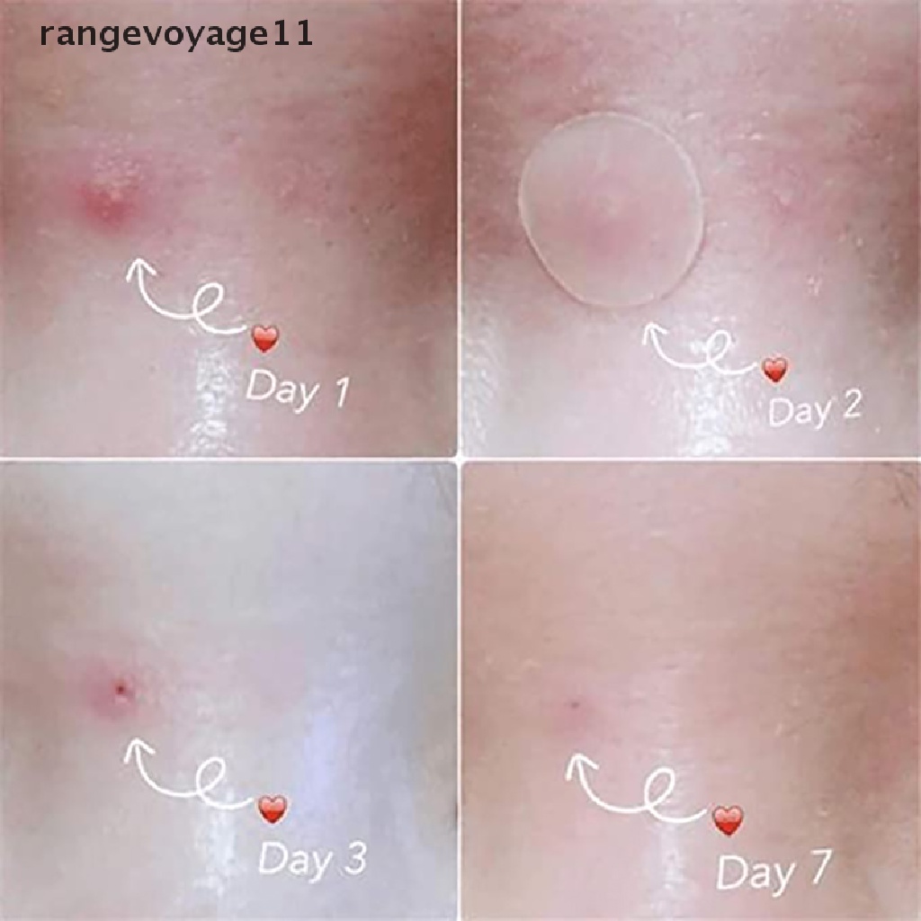Bộ 36 Miếng Dán Mụn Hydrocolloid Và Mụn Trứng Cá Chăm Sóc Da