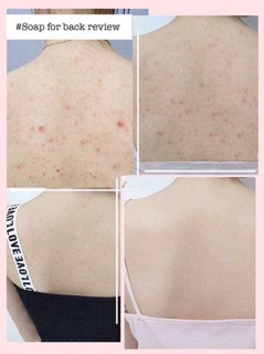 Xà phòng trị mụn lưng For Back