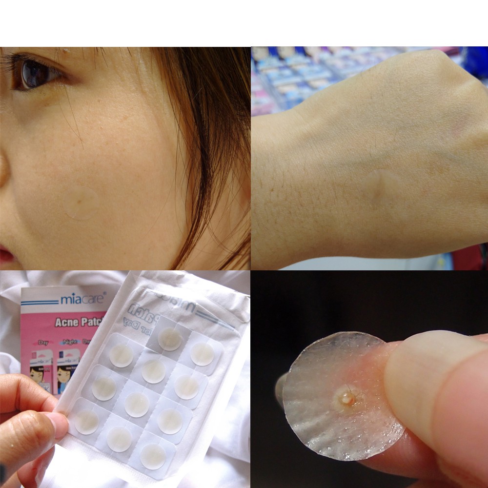 Miếng Dán Mụn Somaderm 12