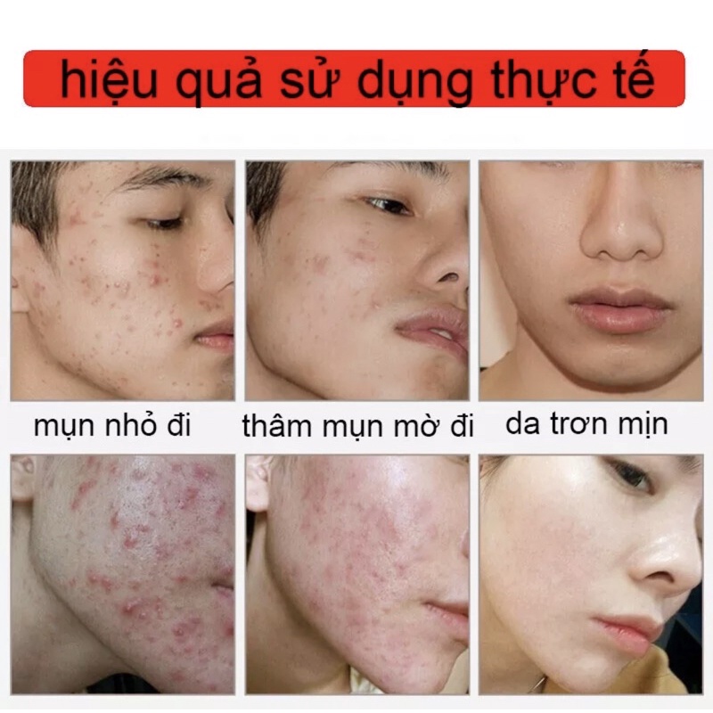 Kem ngừa mụn trứng cá , mụn đầu đen , mụn bọc handmade hiệu quả nhanh lọ 10g