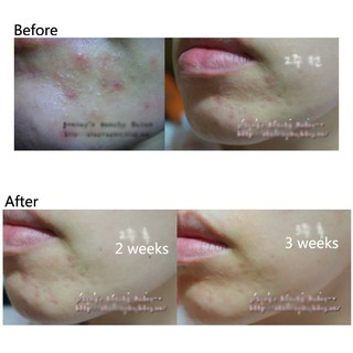 Kem giảm mụn Ciracle Red Spot Cream