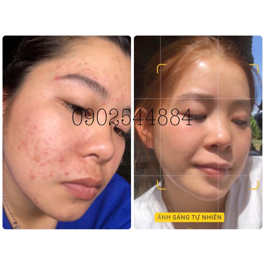 Serum mụn Hoàng Trinh