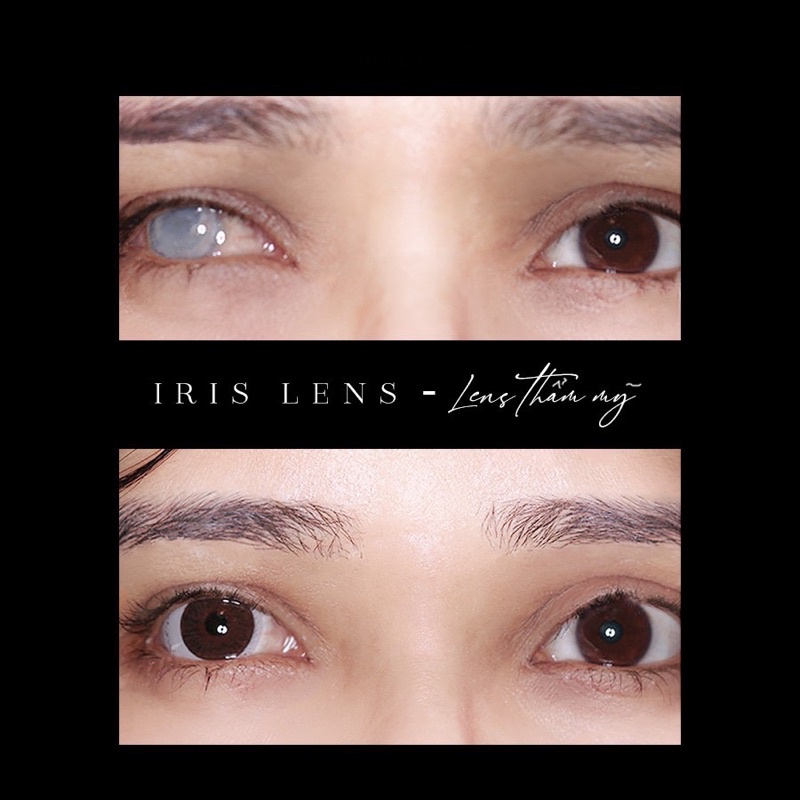 Lens thẩm mỹ kính áp tròng cho mắt hỏng