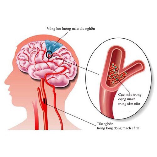 Viên uống Nattospes - Hỗ trợ phòng ngừa và điều trị tai biến mạch máu não (Hộp 30 viên)