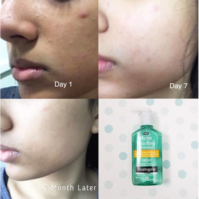 Sữa rửa mặt Neutrogena Acne Proofing Gel Cleanser chuyên dành cho mụn cám và da dầu