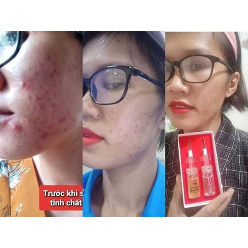 Đánh bay nốt mụn xấu xí cùng vua trị mụn Linh Hương (purity skin)