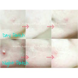 Miếng Dán Mụn Giúp Giảm Sưng Mụn Ngày & Đêm Derma Angel (18 & 24 miếng/hộp) - 0514906 | BigBuy360 - bigbuy360.vn